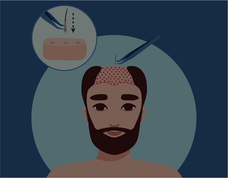 Hair Transplant