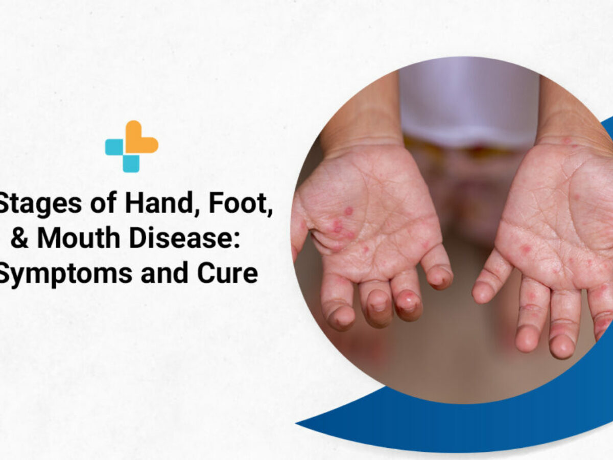 Stages Of Hand, Foot, And Mouth Disease: Symptoms And Cure