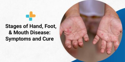 Stages of Hand Foot and Mouth Disease