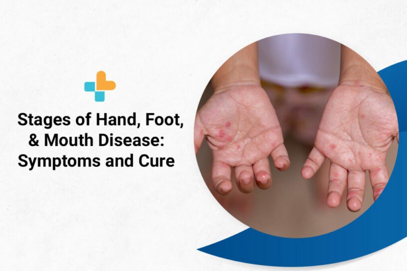 Stages of Hand Foot and Mouth Disease