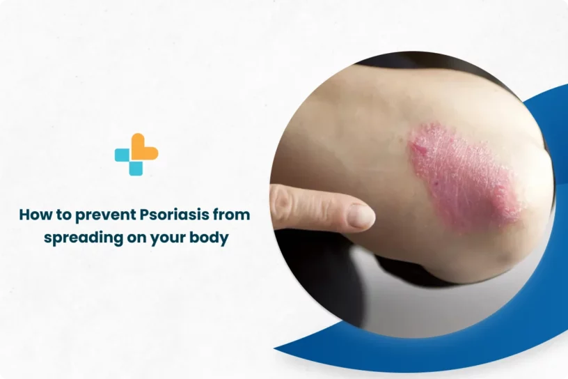 How-to-Prevent-Psoriasis-From-Spreading-On-Your-Body.