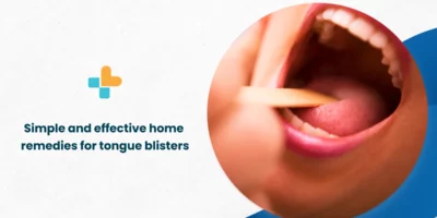 Tongue Blisters