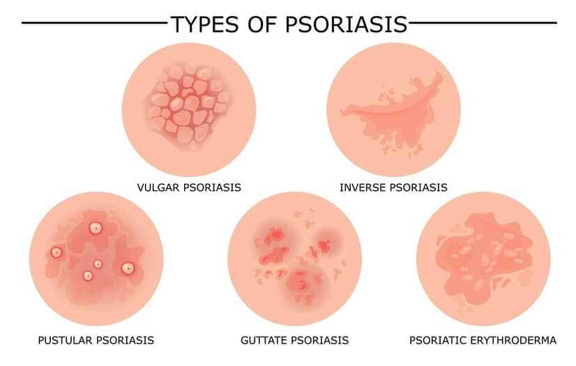 different types psoriasis set 74855 16112 1