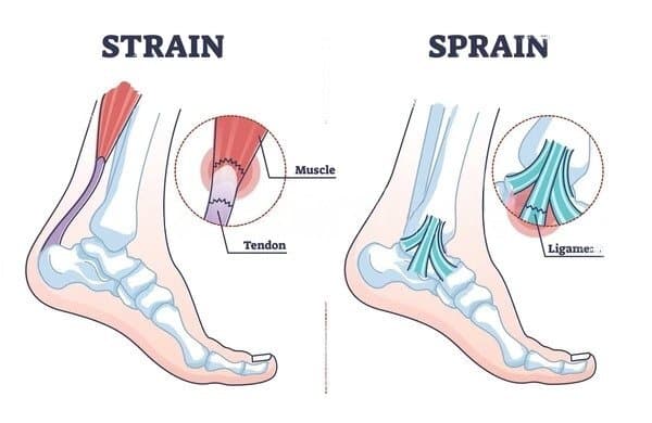 sprain vs strain anatomical comparison 600w