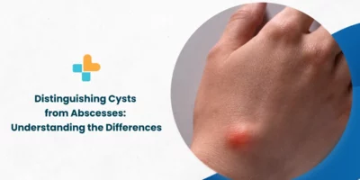 Cysts-from-Abscesses