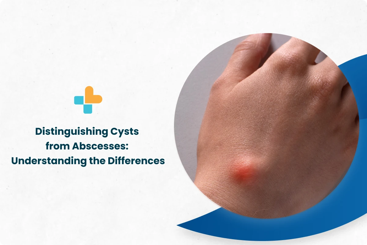 Difference Between A Pilonidal or Sebaceous Cyst