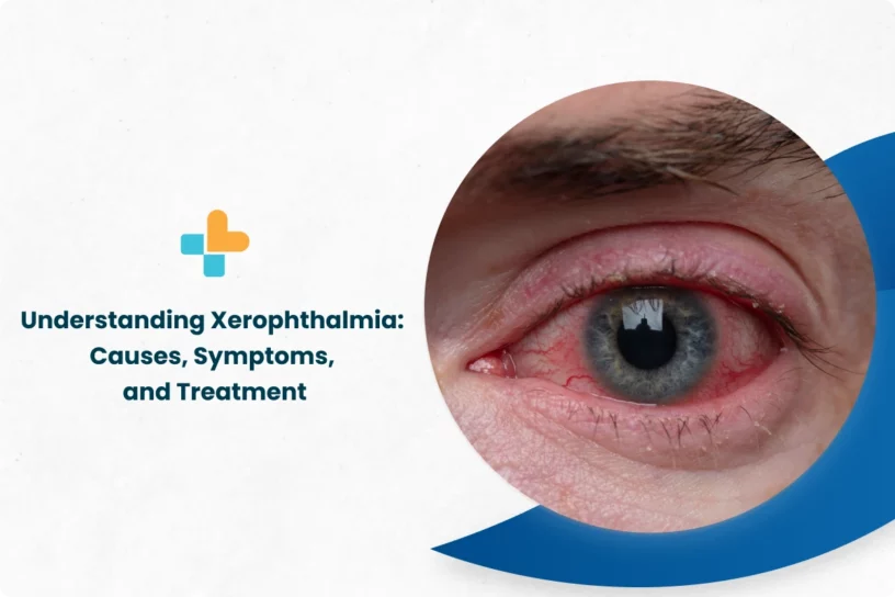 Understanding Xerophthalmia_ Causes, Symptoms, and Treatment