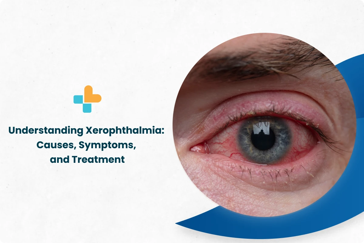 Understanding Xerophthalmia Causes, Symptoms, And Treatment