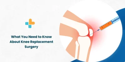 What You Need to Know About Knee Replacement Surgery