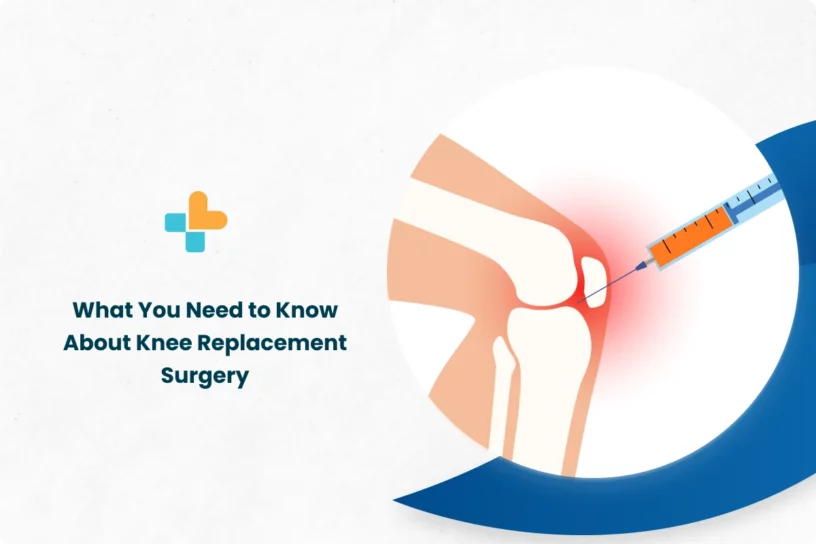 What You Need to Know About Knee Replacement Surgery