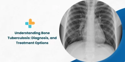 Understanding Bone Tuberculosis