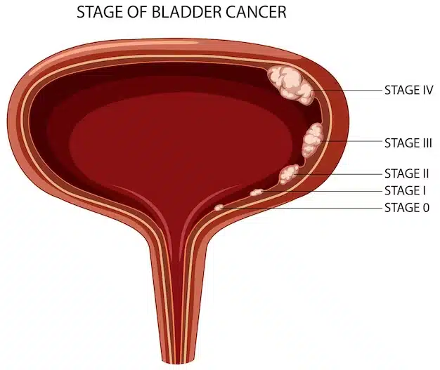 Bladder Cancer Awareness Day