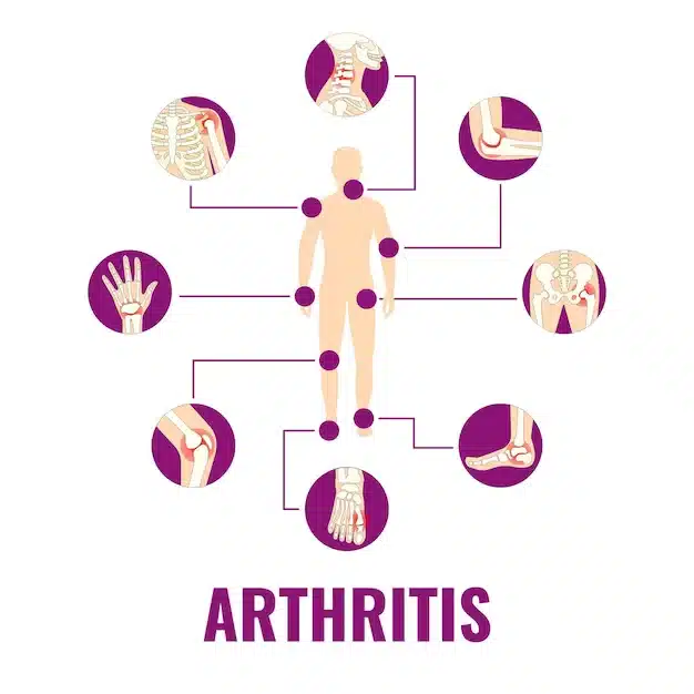 Autoimmune Arthritis 